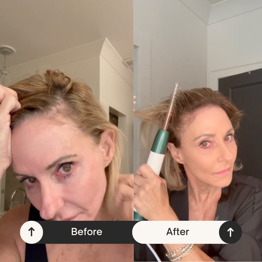 ApexGrow High Technology Hair Growth Wand 🇵🇭