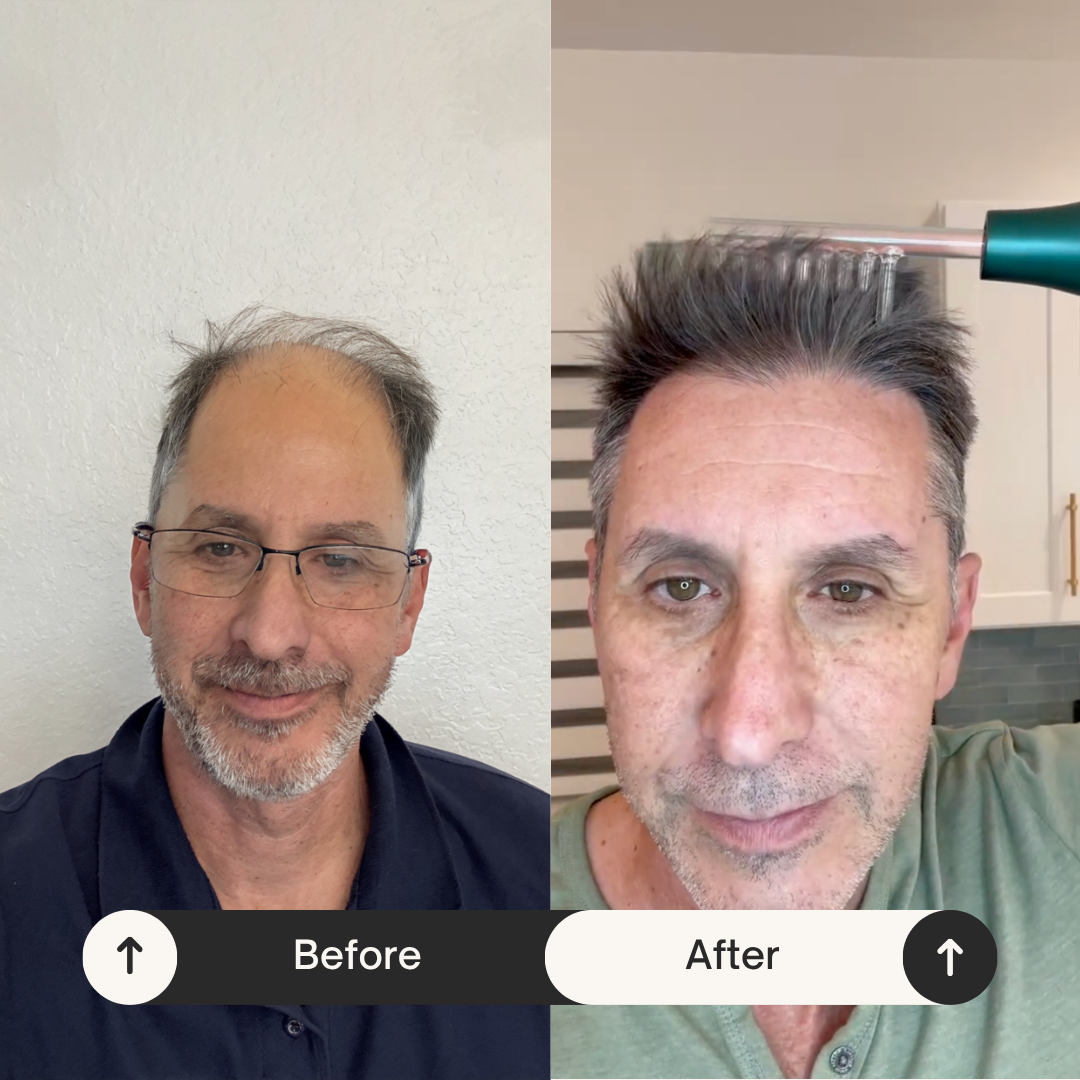 ApexGrow High Technology Hair Growth Wand 🇵🇭